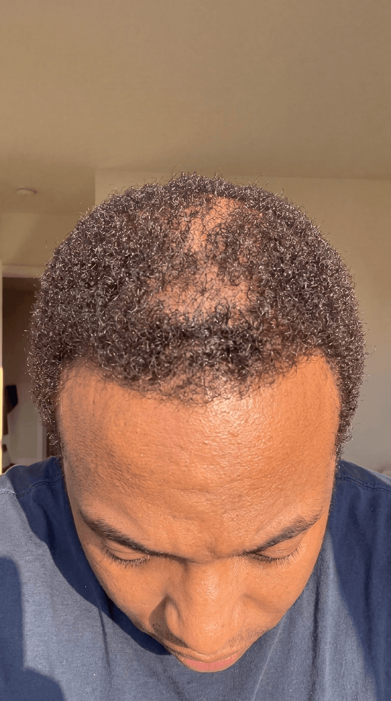 Fill in bald patches before result