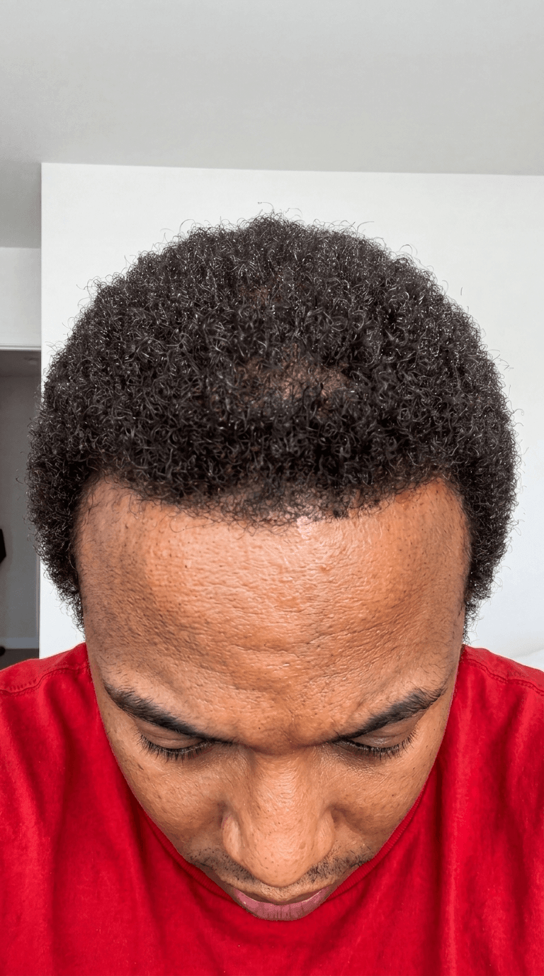 Fill in bald patches after result